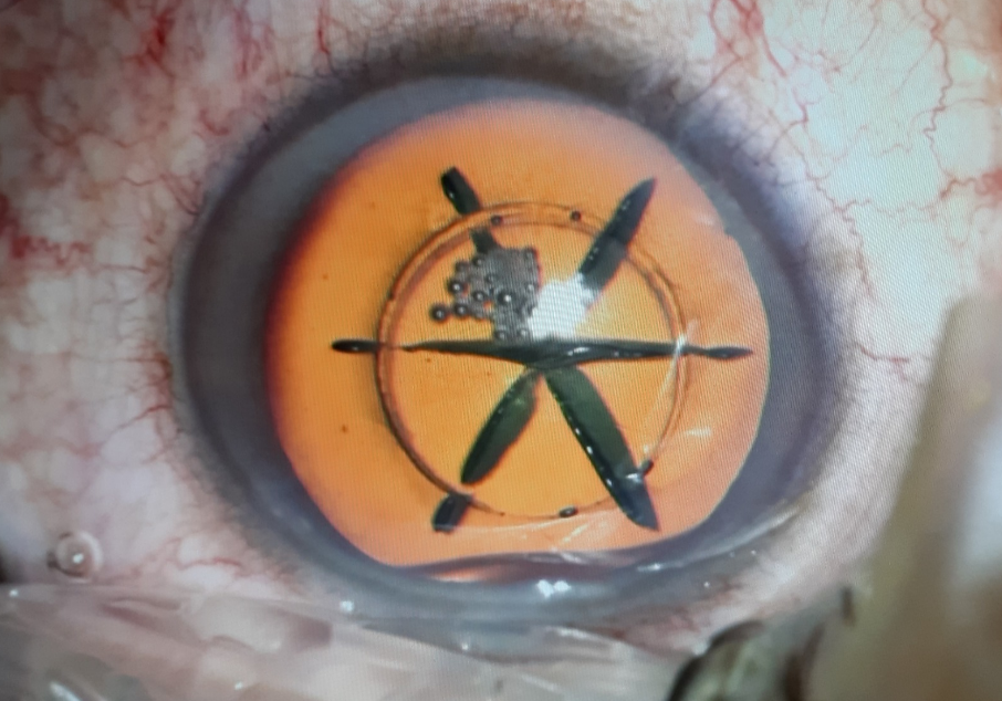 Instrumentación de enfermería en la cirugía oftalmológica - Parte 1